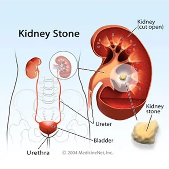 kidney stone formation therapeutic monitoring panel